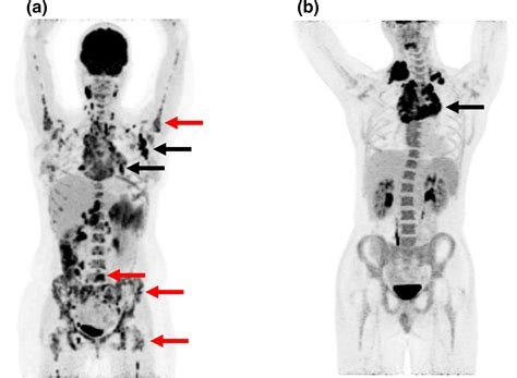 pet scan for lymphoma staging.